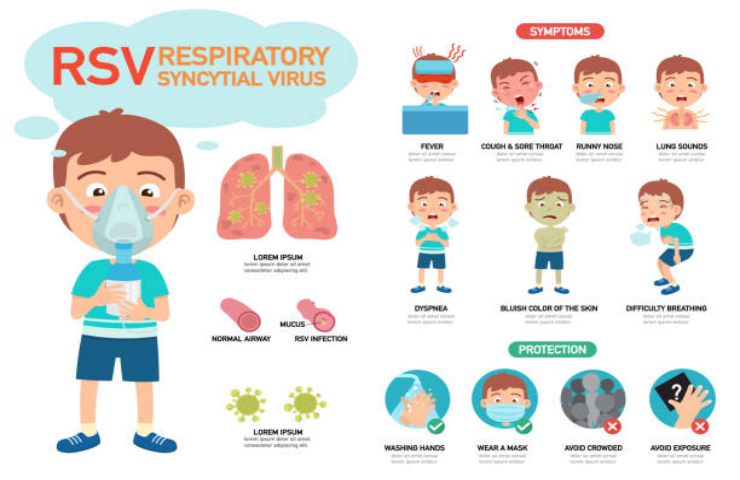 Infografica del virus respiratorio sinciziale