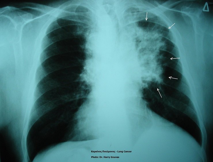 Una radiografia che mostra un tumore al polmone