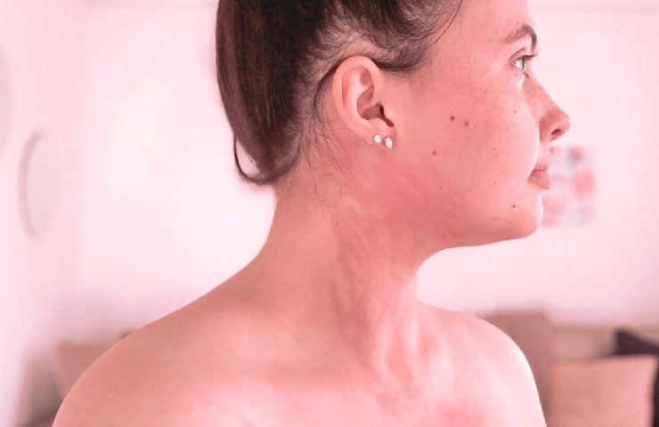 Gli sfoghi dovuti all'allergia sulla pelle di Tessa Hansen Smith
